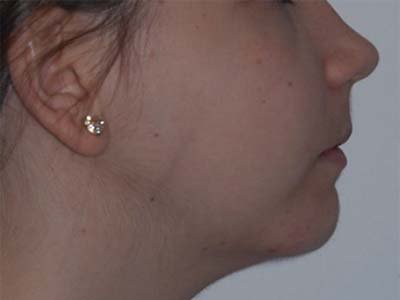 Maxillaire inférieur (mandibule) trop reculé (Classe II)