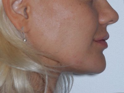 Correction of chin anomalies/positions