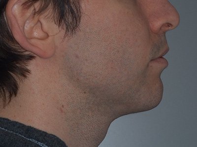 Correction of chin anomalies/positions