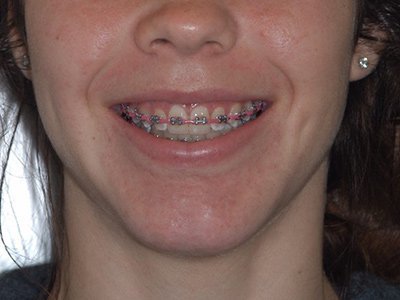 Excess vertical dimension of the maxilla (“Gummy smile”)