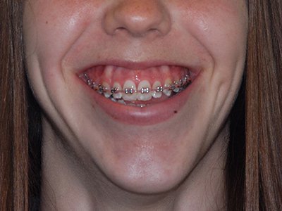 Excès vertical du maxillaire supérieur (sourire gingival)